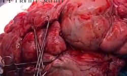 Prof. Dr. Hanifi Şahin’den Dünya Rekoru: 61 cm Miyom