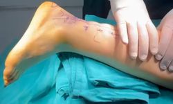 Milli karateci Aylin, kapalı yöntemle yapılan aşil tendonu ameliyatıyla sağlığına kavuştu