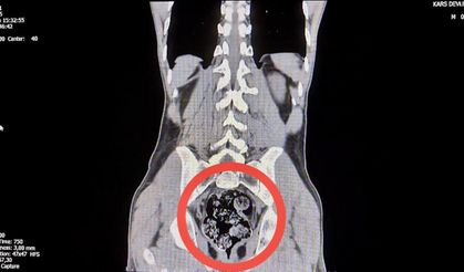 Röntgenle tespit edilen uyuşturucu cerrahi operasyonla çıkarıldı