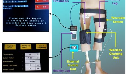 Türk akademisyenler, kemik kanseri tedavisi için tümör protezi geliştirdi
