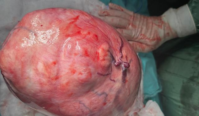 Karın şişliği rahatsızlığı olan 34 yaşındaki hastadan 10 kiloluk “Dev Miyom” çıktı