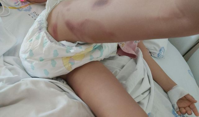 3 yaşındaki Yaren ameliyattan yanık izleriyle çıktı, aile suç duyurusunda bulundu