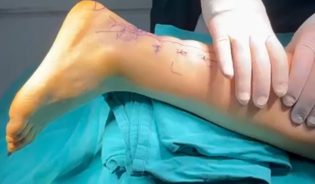 Milli karateci Aylin, kapalı yöntemle yapılan aşil tendonu ameliyatıyla sağlığına kavuştu